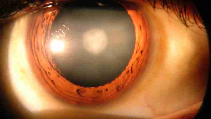 Cataract in human eye, tags: grauen und - CC BY-SA